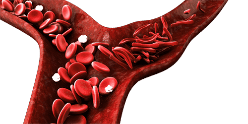 Understanding Sickle Cell Anemia