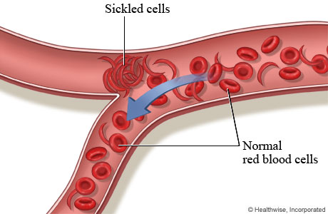 Effects of Sickle Cell Anaemia on Employment