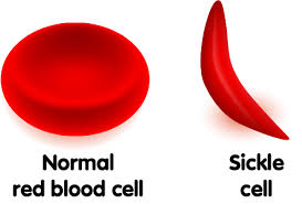 Sickle Cell Anemia – What to Expect